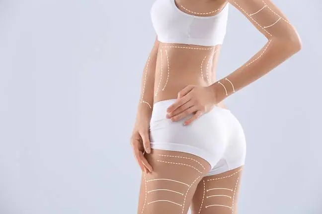 Young woman with marks for liposuction operation and space for text on light background. Cosmetic surgery
