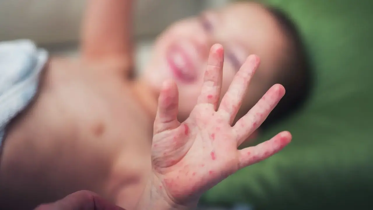 Menor afectado por sarampión (Foto: Canal Salud)