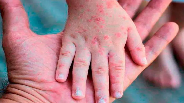 Síntomas de viruela del mono en la piel.