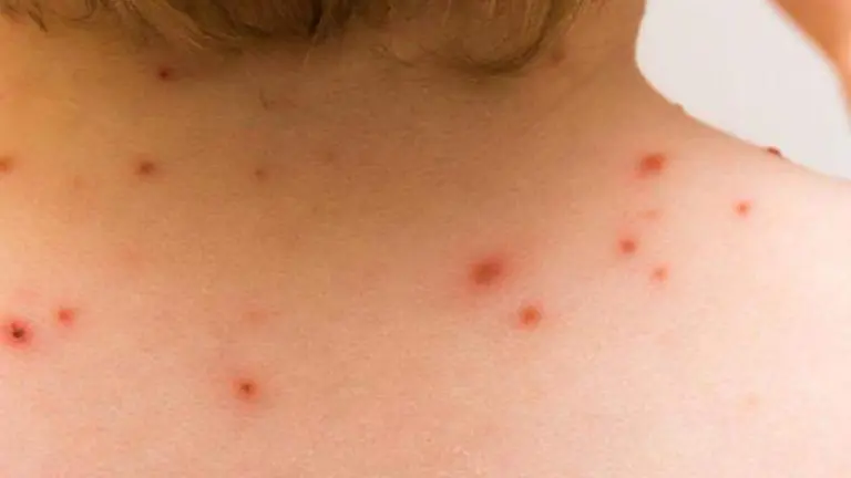 Afección por viruela del mono.