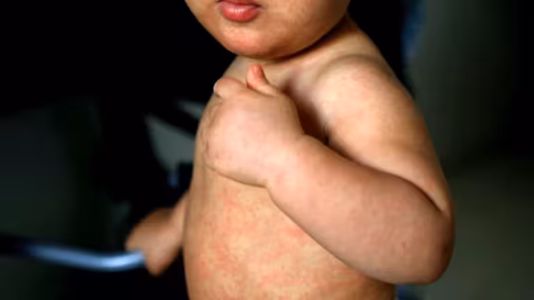 Un ni&ntilde;o afectado por sarampi&oacute;n (Foto: OPS)